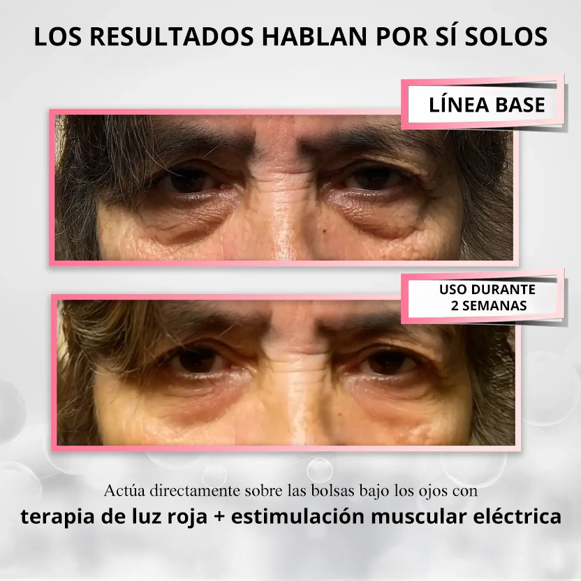 RevitalEyes™ Terapia de luz roja 2 en 1 + EMS para eliminar las bolsas de los ojos