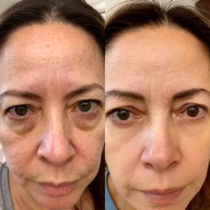 RevitalEyes™ Terapia de luz roja 2 en 1 + EMS para eliminar las bolsas de los ojos